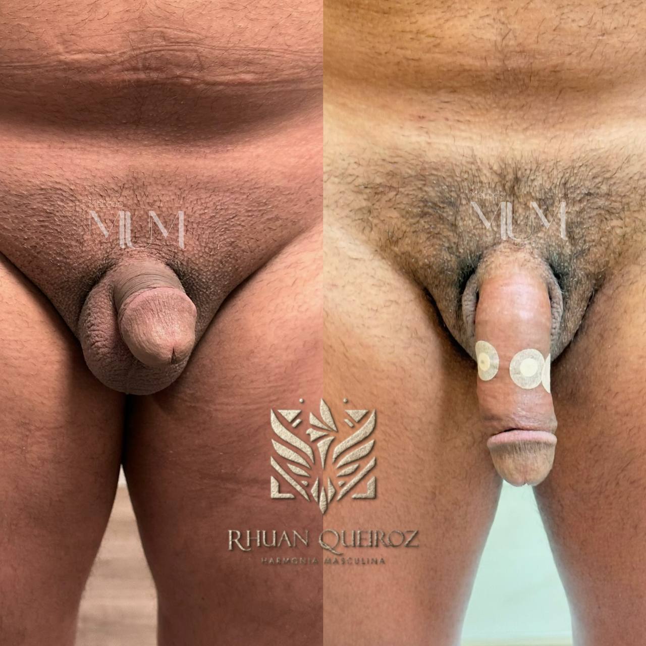 Resultado antes e depois compartilhado por paciente